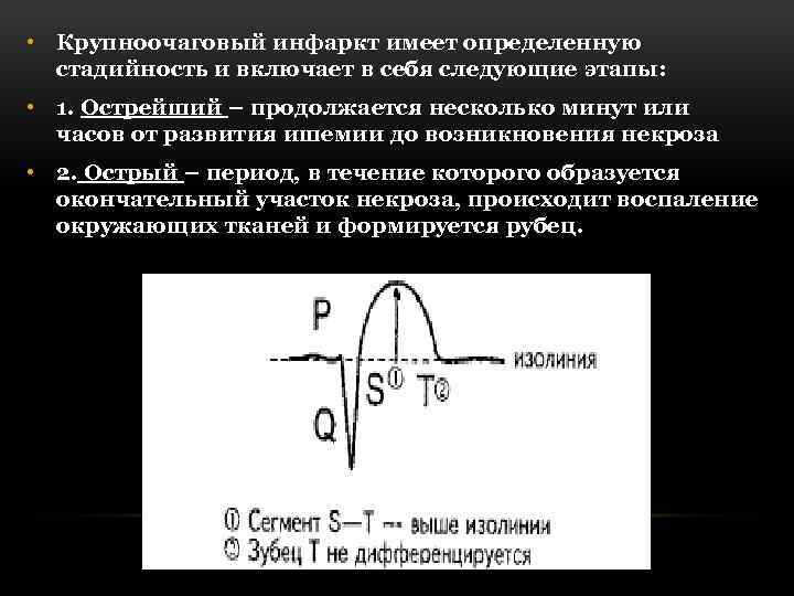  • Крупноочаговый инфаркт имеет определенную стадийность и включает в себя следующие этапы: •