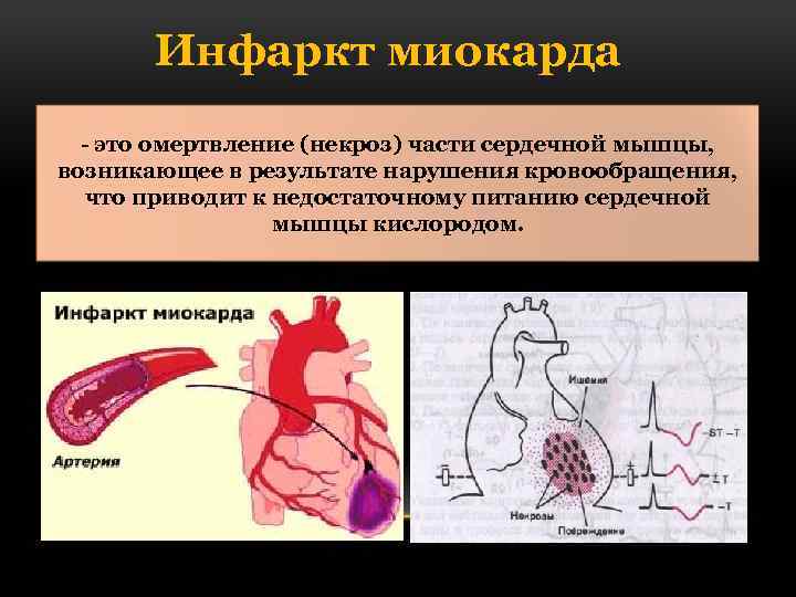 Обширный инфаркт это простыми словами. Некроз сердечной мышцы. Обширный инфаркт миокарда. Инфаркт миокарда некроз. Нарушения гемодинамики при инфаркте миокарда.