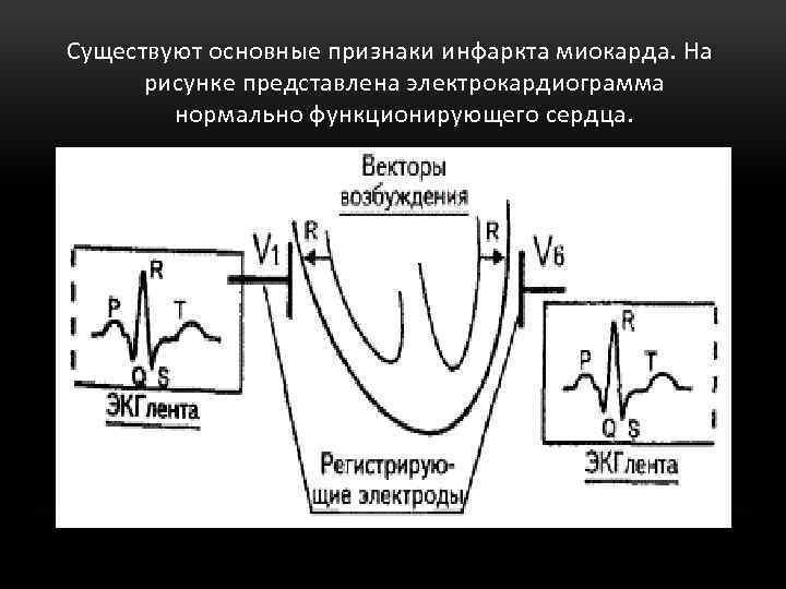 Существуют основные признаки инфаркта миокарда. На рисунке представлена электрокардиограмма нормально функционирующего сердца. 