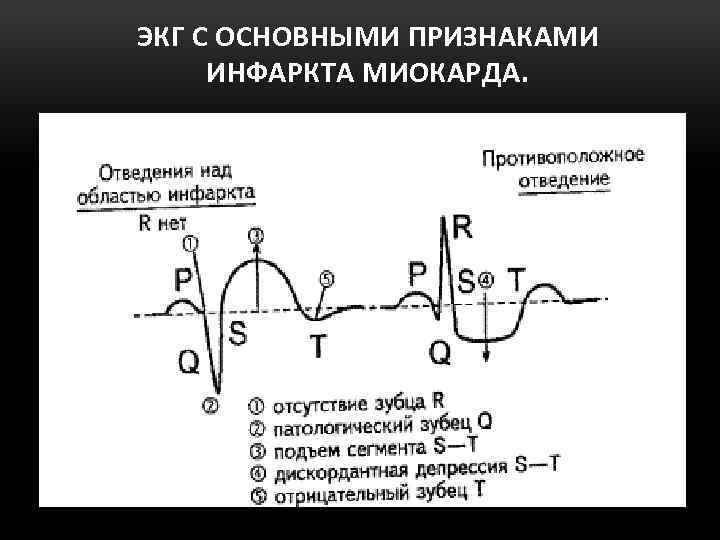 ЭКГ С ОСНОВНЫМИ ПРИЗНАКАМИ ИНФАРКТА МИОКАРДА. 