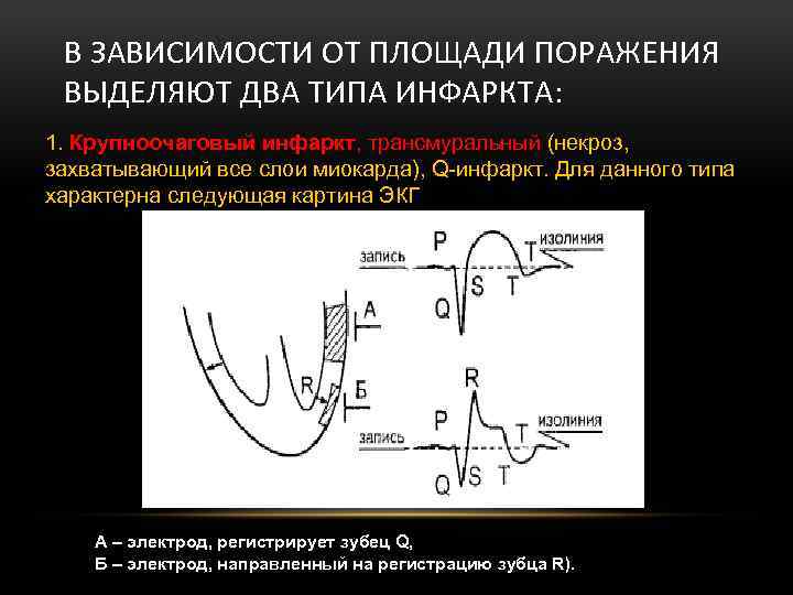 В ЗАВИСИМОСТИ ОТ ПЛОЩАДИ ПОРАЖЕНИЯ ВЫДЕЛЯЮТ ДВА ТИПА ИНФАРКТА: 1. Крупноочаговый инфаркт, трансмуральный (некроз,