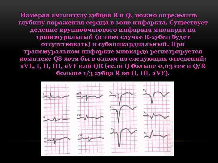 Измеряя амплитуду зубцов R и Q, можно определить глубину поражения сердца в зоне инфаркта.