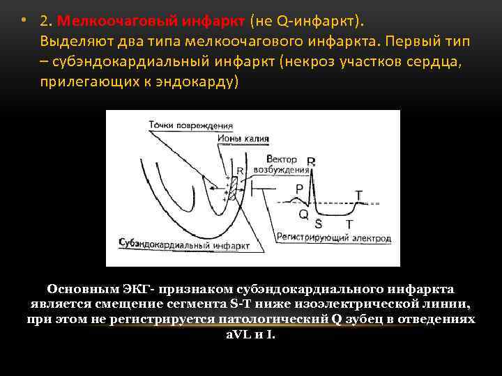  • 2. Мелкоочаговый инфаркт (не Q-инфаркт). Выделяют два типа мелкоочагового инфаркта. Первый тип