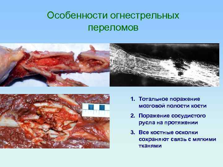 Особенности огнестрельных переломов 1. Тотальное поражение мозговой полости кости 2. Поражение сосудистого русла на