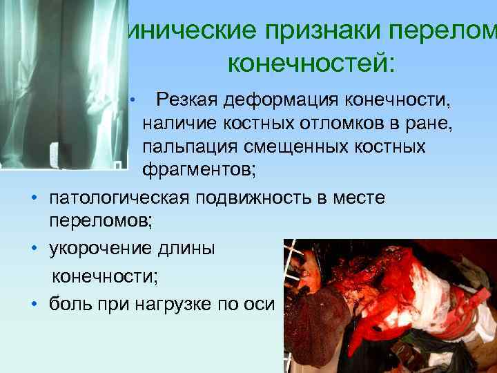 Клинические признаки перелом конечностей: Резкая деформация конечности, наличие костных отломков в ране, пальпация смещенных