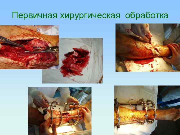 Первичная хирургическая обработка 