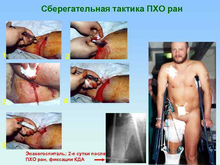 Сберегательная тактика ПХО ран 1 2 3 4 5 Эвакогоспиталь; 2 -е сутки после