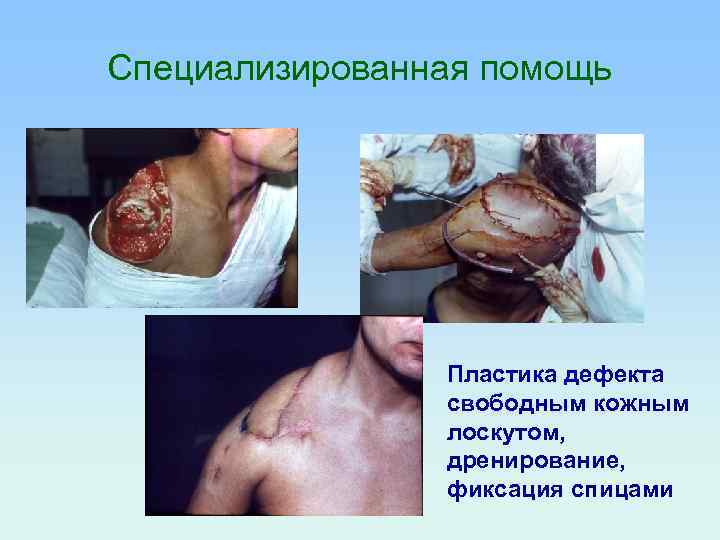 Специализированная помощь Пластика дефекта свободным кожным лоскутом, дренирование, фиксация спицами 