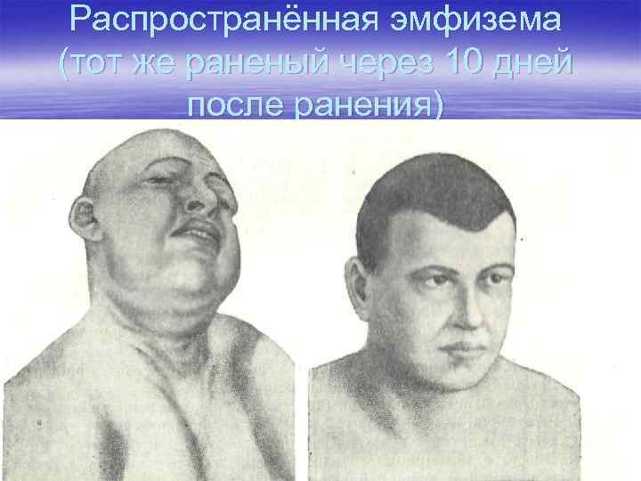 Распространённая эмфизема (тот же раненый через 10 дней после ранения) 
