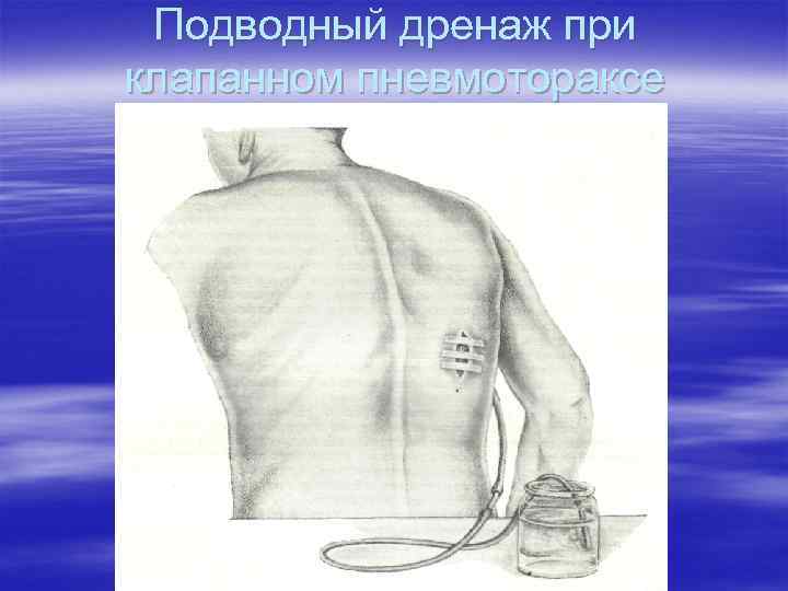 Подводный дренаж при клапанном пневмотораксе 