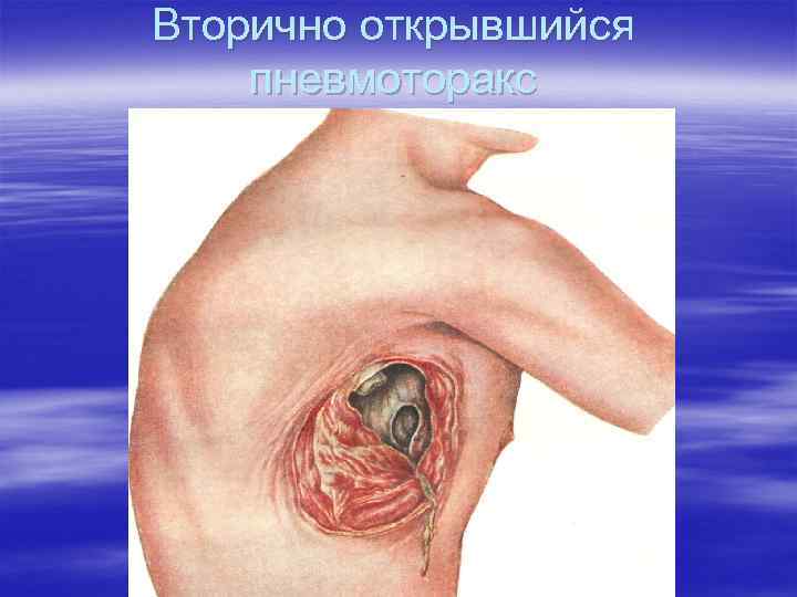 Вторично открывшийся пневмоторакс 