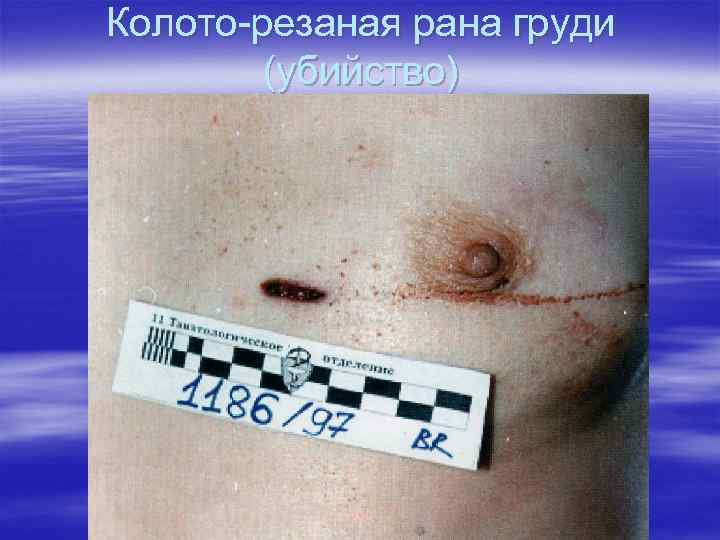 Колото-резаная рана груди (убийство) 