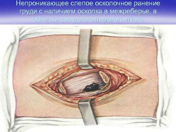 Непроникающее слепое осколочное ранение груди с наличием осколка в межреберье, в области сосудисто-нервного пучка
