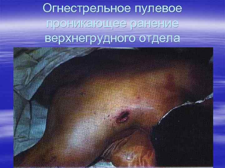 Огнестрельное пулевое проникающее ранение верхнегрудного отдела 