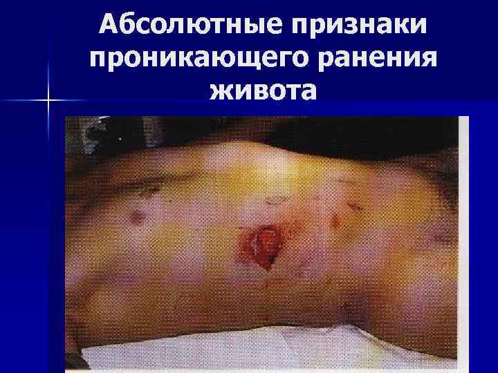 Абсолютные признаки проникающего ранения живота 