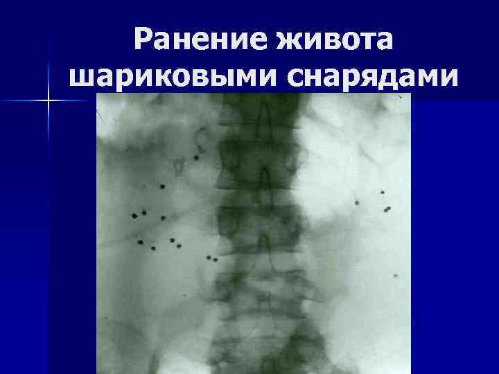 Ранение живота шариковыми снарядами 