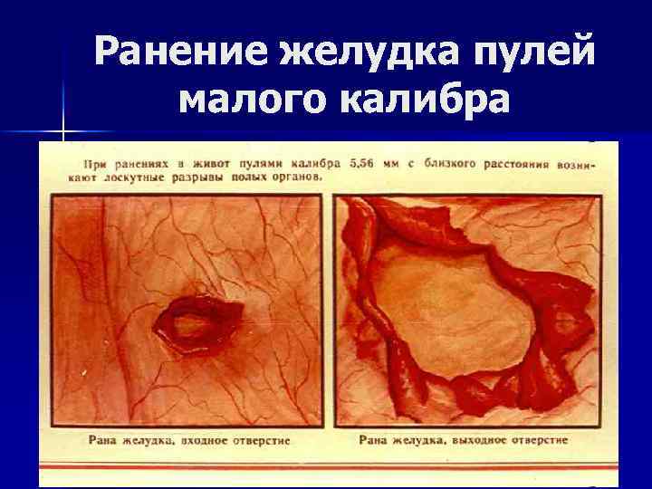 Ранение желудка пулей малого калибра 