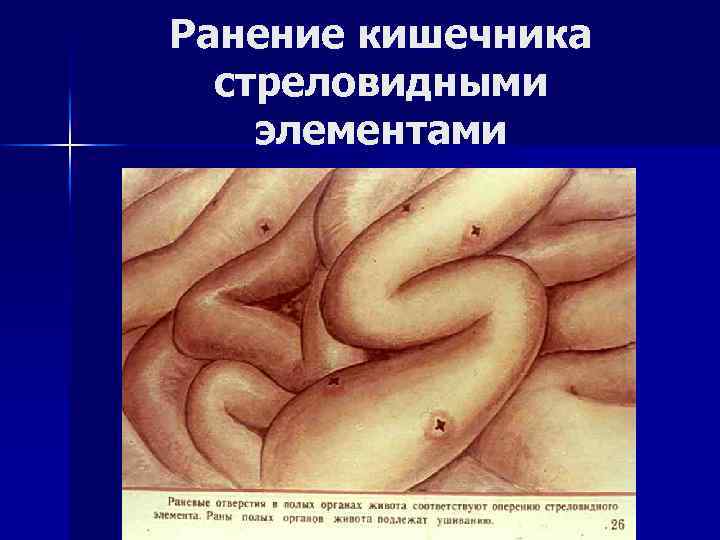 Ранение кишечника стреловидными элементами 