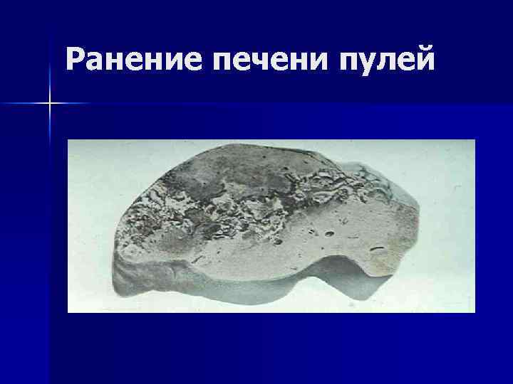 Ранение печени пулей 