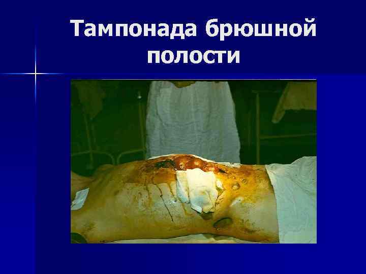 Тампонада брюшной полости 