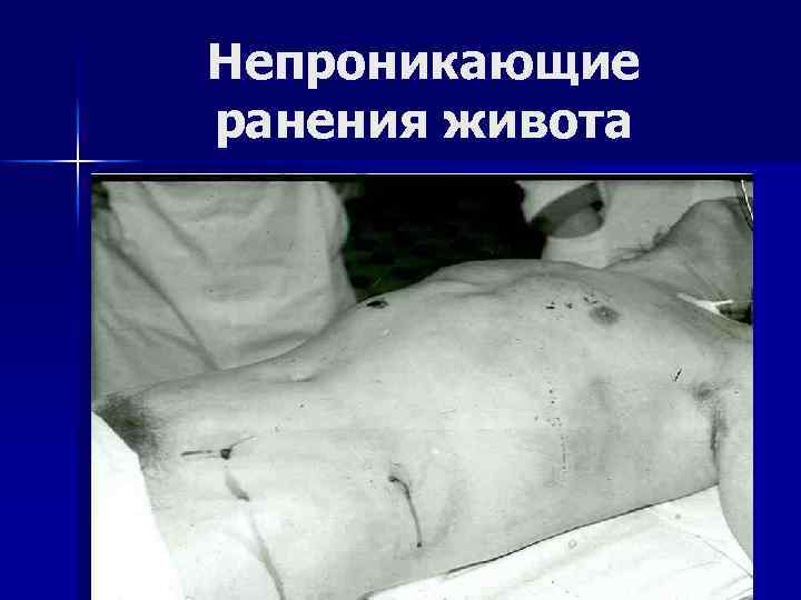Непроникающие ранения живота 