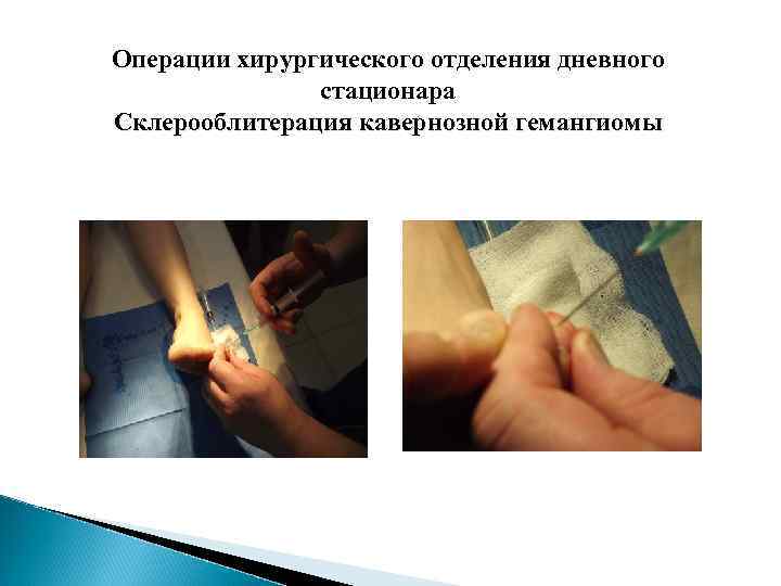 Операции хирургического отделения дневного стационара Склерооблитерация кавернозной гемангиомы 