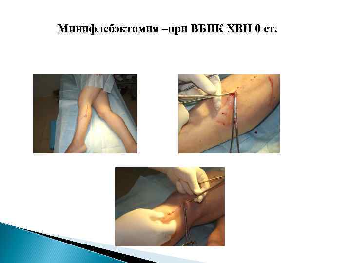 Минифлебэктомия –при ВБНК ХВН 0 ст. 