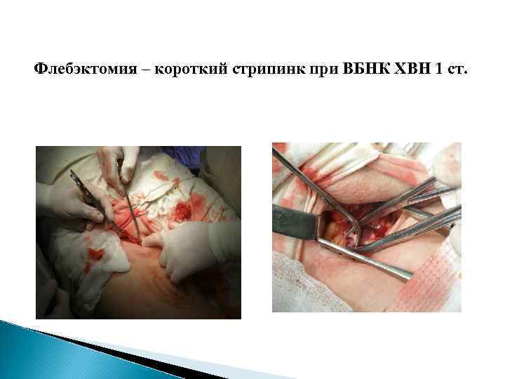 Флебэктомия – короткий стрипинк при ВБНК ХВН 1 ст. 