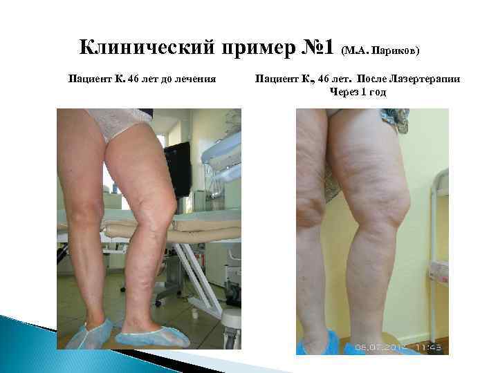 Клинический пример № 1 (М. А. Париков) Пациент К. 46 лет до лечения Пациент