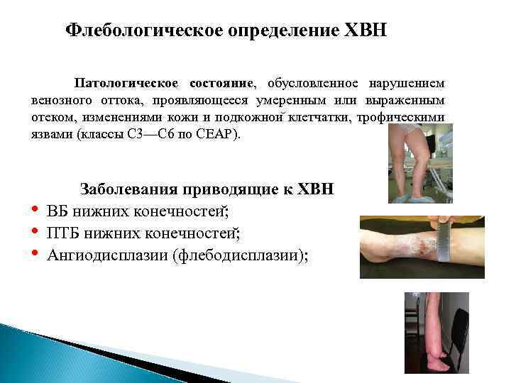 Флебологическое определение ХВН Патологическое состояние, обусловленное нарушением венозного оттока, проявляющееся умеренным или выраженным отеком,