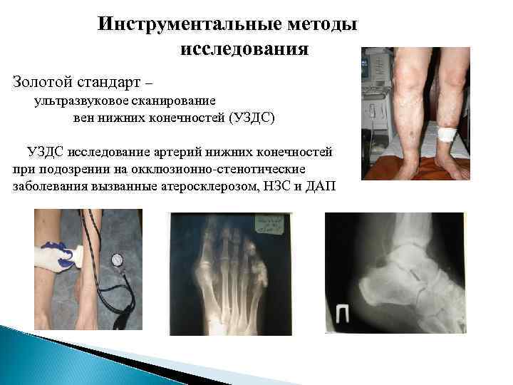 Инструментальные методы исследования Золотой стандарт – ультразвуковое сканирование вен нижних конечностей (УЗДС) УЗДС исследование