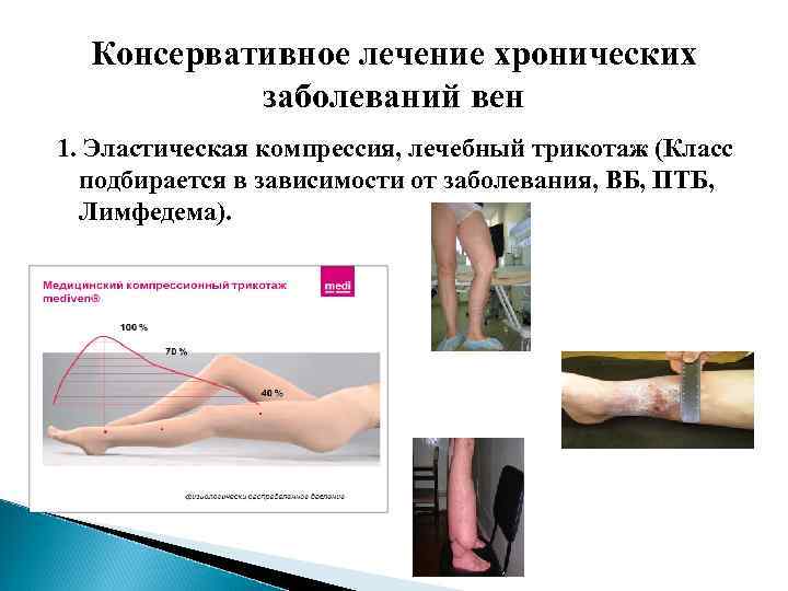 Консервативное лечение хронических заболеваний вен 1. Эластическая компрессия, лечебный трикотаж (Класс подбирается в зависимости