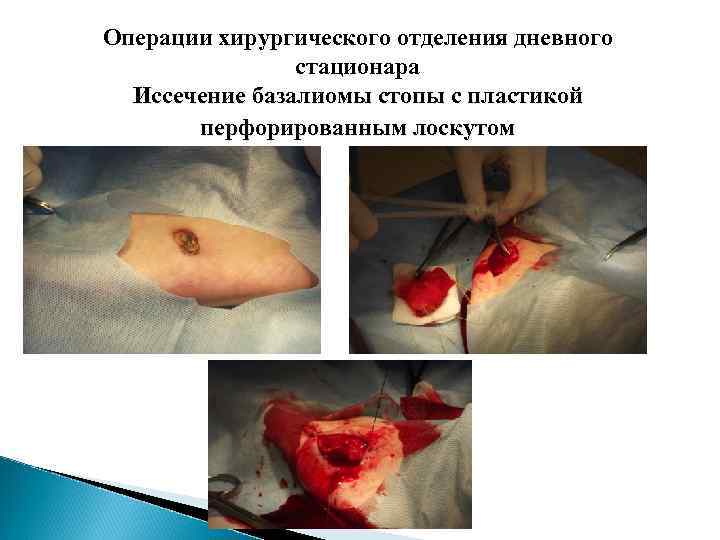 Операции хирургического отделения дневного стационара Иссечение базалиомы стопы с пластикой перфорированным лоскутом 