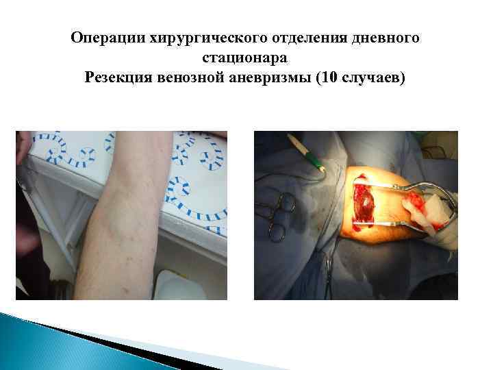 Операции хирургического отделения дневного стационара Резекция венозной аневризмы (10 случаев) 