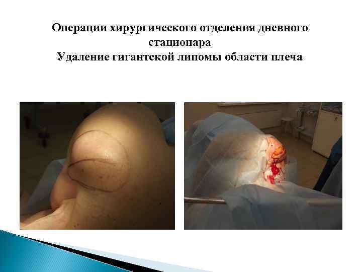 Операции хирургического отделения дневного стационара Удаление гигантской липомы области плеча 
