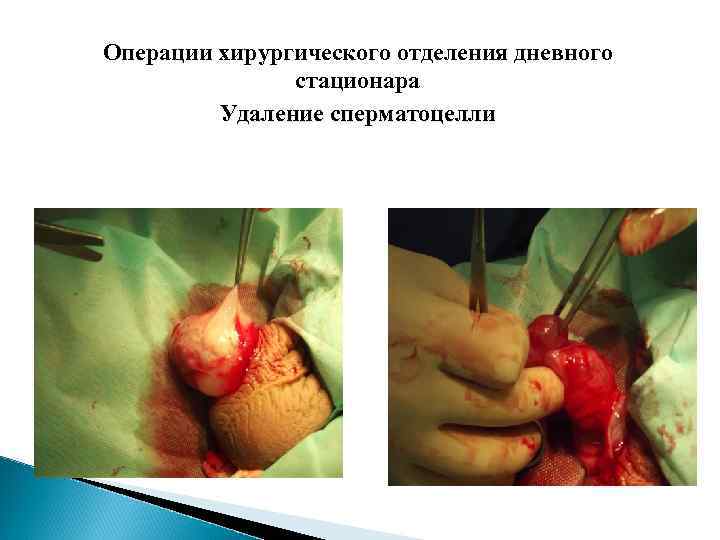 Операции хирургического отделения дневного стационара Удаление сперматоцелли 