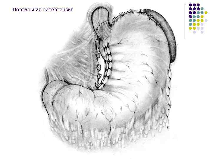 Портальная гипертензия 