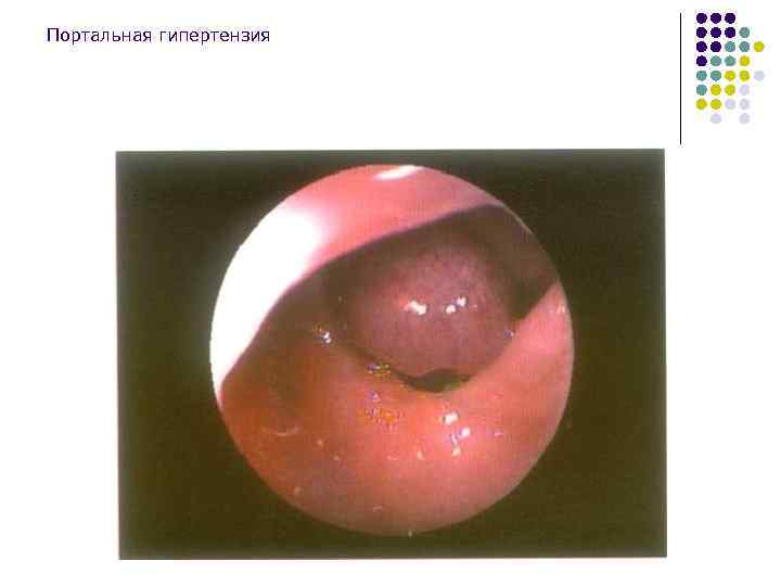 Портальная гипертензия 