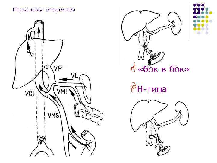 Портальная гипертензия G «бок в бок» HН-типа 