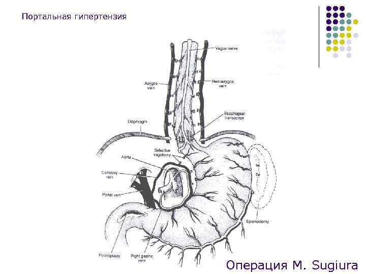 Портальная гипертензия Операция M. Sugiura 