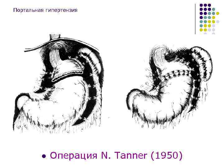 Портальная гипертензия l Операция N. Tanner (1950) 