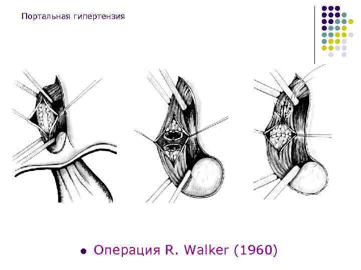 Портальная гипертензия l Операция R. Walker (1960) 