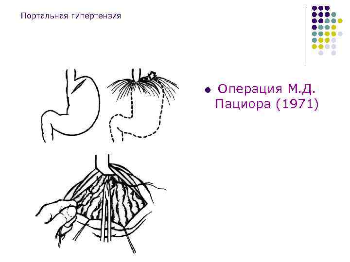 Портальная гипертензия l Операция М. Д. Пациора (1971) 