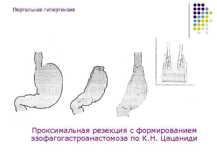 Портальная гипертензия Проксимальная резекция с формированием эзофагогастроанастомоза по К. Н. Цацаниди 