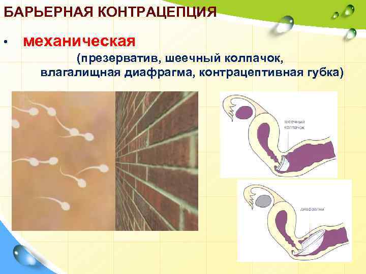 БАРЬЕРНАЯ КОНТРАЦЕПЦИЯ • механическая (презерватив, шеечный колпачок, влагалищная диафрагма, контрацептивная губка) 