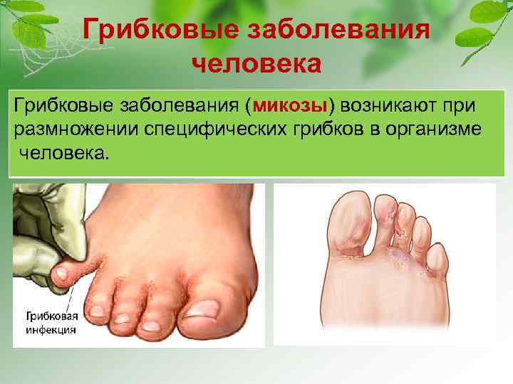 Грибковые заболевания человека Грибковые заболевания (микозы) возникают при размножении специфических грибков в организме человека.