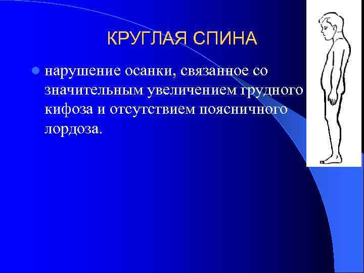  КРУГЛАЯ СПИНА l нарушение осанки, связанное со значительным увеличением грудного кифоза и отсутствием