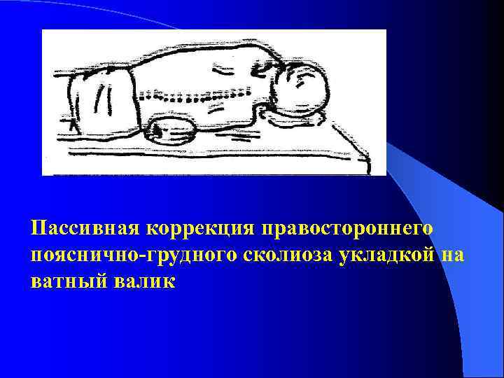 Пассивная коррекция правостороннего пояснично-грудного сколиоза укладкой на ватный валик 