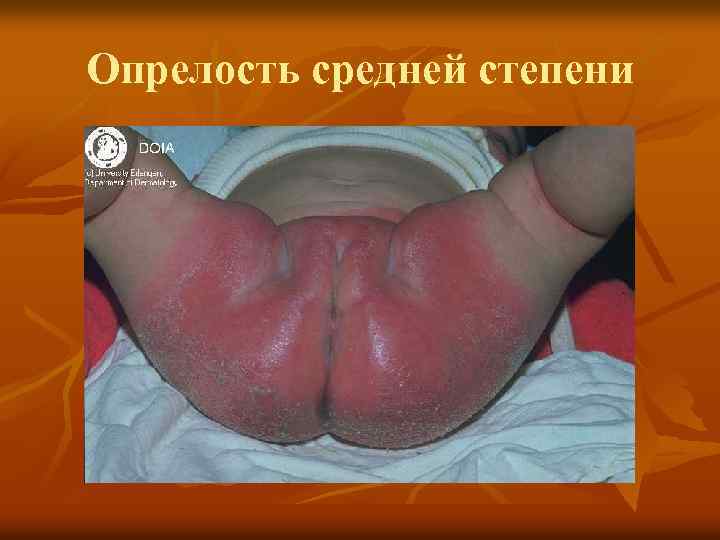 Опрелость средней степени 