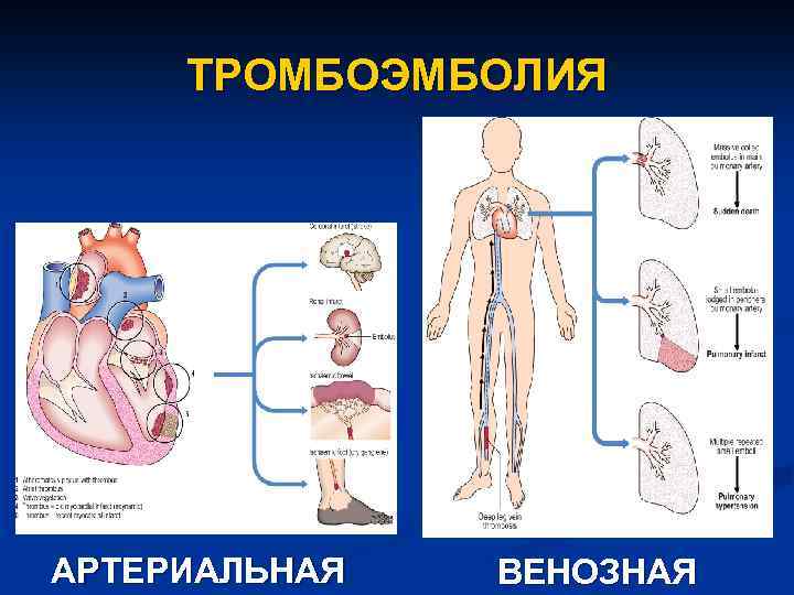 Тромбоз и эмболия. Нарушения кровообращения тромбоэмболия. Артериальная и венозная тромбоэмболия. Исход и осложнения эмболии. Нарушения кровообращения тромбоз эмболия.